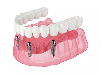 Dental Smiles of Bolingbrook | Sports Mouthguards, Sedation Dentistry and LANAP   Laser Dentistry